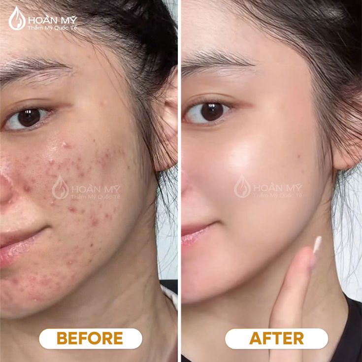 Hyaluronic Acid Serum (Pore Minimizing & Skin-Lifting)