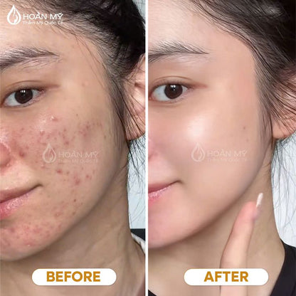 Hyaluronic Acid Serum (Pore Minimizing & Skin-Lifting)